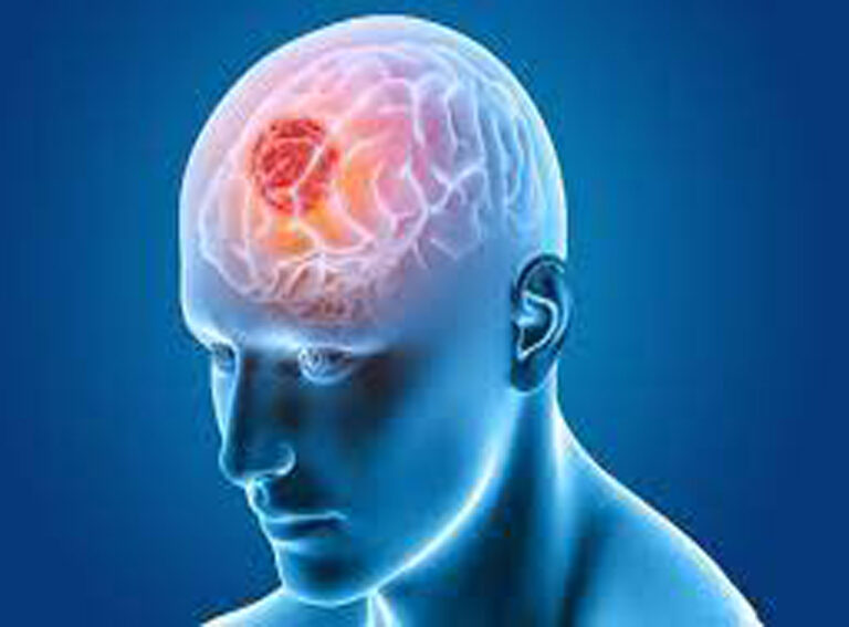 Understanding Brain Tumours:- Causes, Symptoms & Treatment