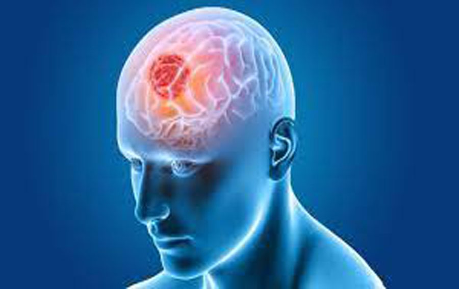 Read more about the article Understanding Brain Tumours:- Causes, Symptoms & Treatment